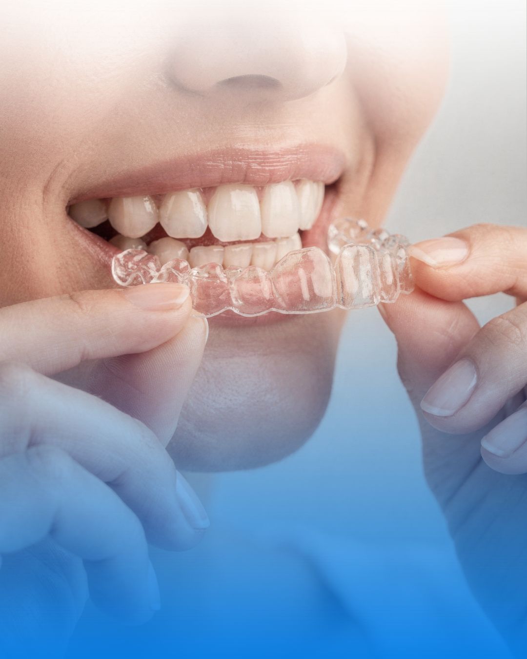 Invisalign