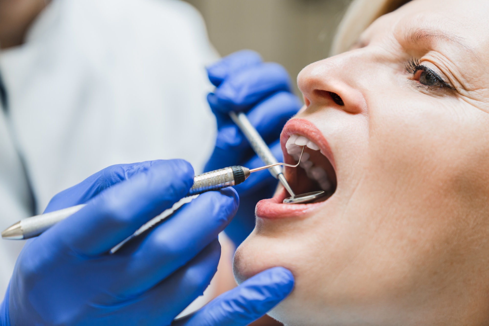 Dental Fillings